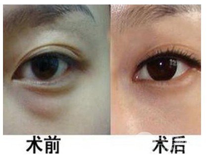 抽脂去眼袋手術(shù)利弊