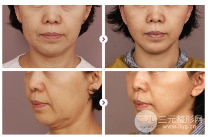 熱瑪吉緊膚除皺適合多大年齡的人做