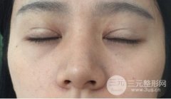 二次調(diào)整，雙眼皮修復(fù)前后注意事項(xiàng)!