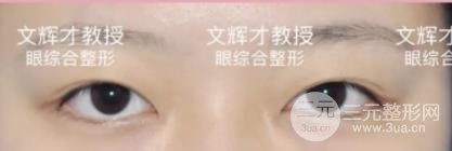 雙眼皮修復前后注意事項