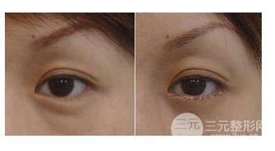 抽脂去除眼袋降低風(fēng)險嗎