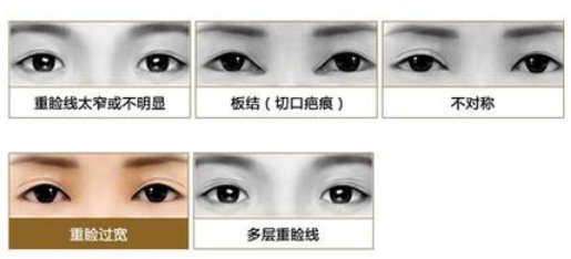 雙眼皮修復前后注意事項