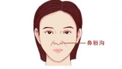 鼻唇溝填充術打玻尿酸成好嗎？前后照片