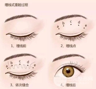 韓式定點雙眼皮跟埋線的區(qū)別