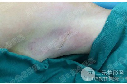 除腋臭手術(shù)有后遺癥嗎