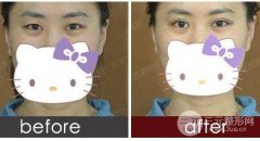 做雙眼皮有幾種方法?操作方法及適用人群