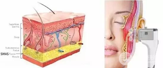 熱拉提美容單次價(jià)格