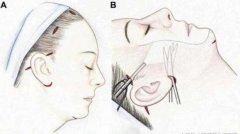 內(nèi)窺鏡除皺手術(shù)能保持多久？果怎么樣？