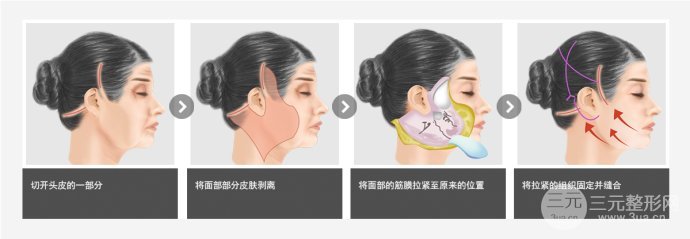 面部除皺術(shù)價(jià)格