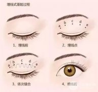 [拒絕衰老]眼部提升手術(shù)講解，掩藏你的年齡秘密！