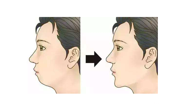 假體下巴恢復(fù)過程圖片
