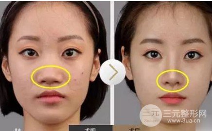 注射瘦臉注射縮鼻頭