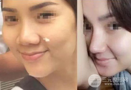 注射瘦臉注射縮鼻頭