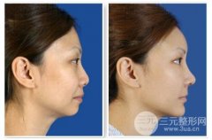 墊下巴前后對(duì)比圖|男生能不能墊下巴?