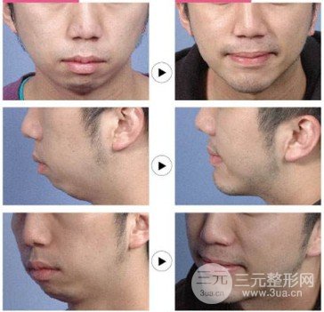 自體脂肪隆下巴維持時間