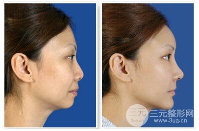 自體脂肪隆下巴維持時間