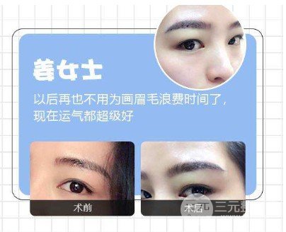 眉部整形有哪些方式