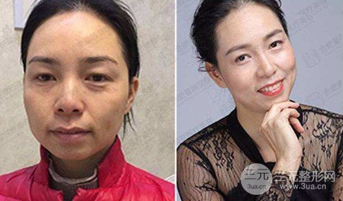 眉部整形有哪些方式