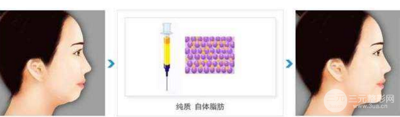 自體脂肪豐下巴