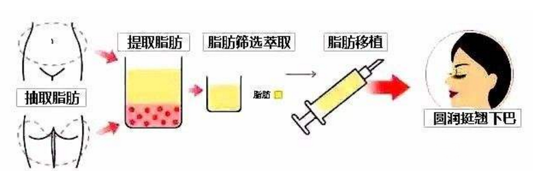 自體脂肪豐下巴