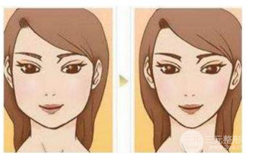 改臉型手術多少錢