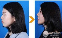 隆下巴價(jià)格多少，三甲醫(yī)院用什么方式隆下巴？