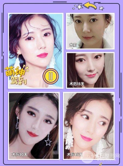 隆下巴價格多少