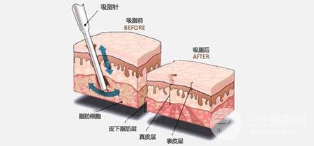 手臂瘦手臂吸脂手術(shù)價格貴嗎？大概多少錢？