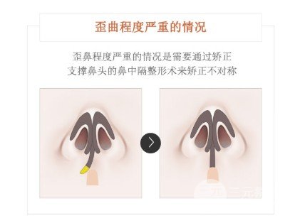 歪鼻整形的價格