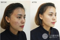 像素激光果真的有嗎?來瞧一眼真人案例~