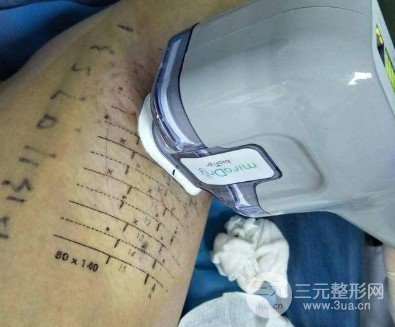 微創(chuàng)去除狐臭是什么