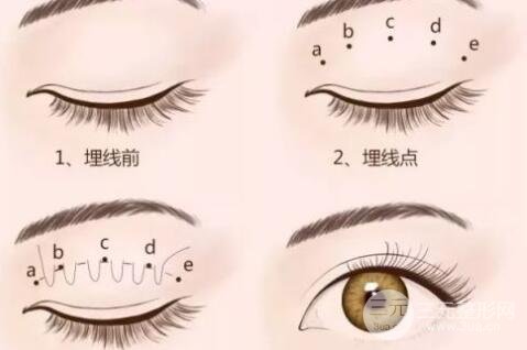 常見雙眼皮介紹：