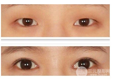開大眼角手術(shù)果對比圖