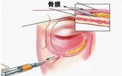 玻尿酸填充淚溝能保持多久?如何*保持果?