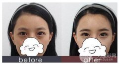 眼下衰老較致命—淚溝填充價(jià)格多少?