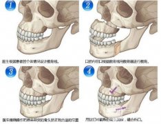 五官很好看就是臉太寬!削骨瘦臉價格多少?