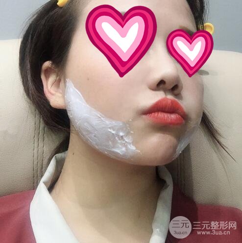 注射瘦臉瘦臉果圖