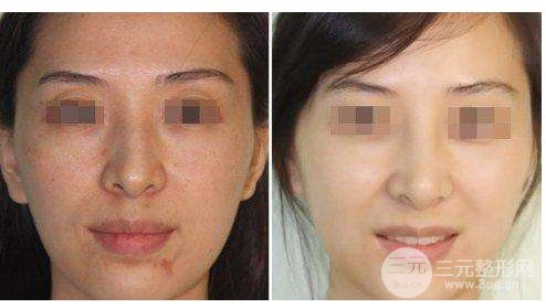 注射注射美白的價(jià)格