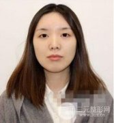 脂肪填充下巴還沒恢復(fù)好丑！熬過恢復(fù)期美如畫