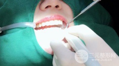 冷光美白牙齒的價格