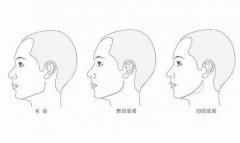 磨骨手術(shù)對比照片，再也沒有人叫我大臉貓了