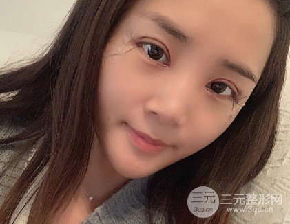 吳慧玲雙眼皮修復(fù)經(jīng)歷