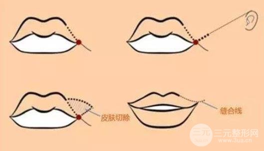 m唇手術對比照圖片，手術方法及術后護理匯總~
