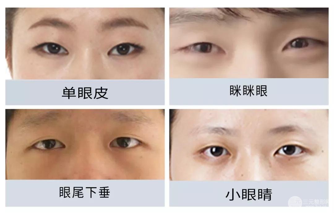 雙眼皮手術(shù)價格