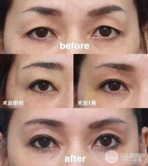 提眉術(shù)前后對(duì)比照片