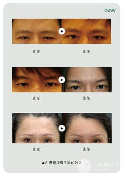 提眉術(shù)前后對(duì)比照片