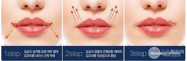 m唇手術(shù)步驟圖片