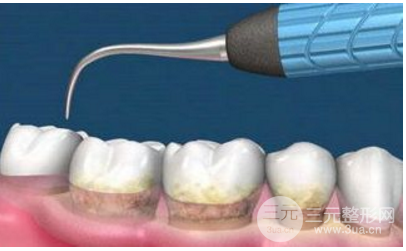 超聲波潔牙多少錢