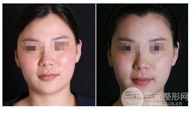 熱瑪吉費用詳解