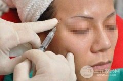 玻尿酸豐太陽(yáng)穴要多少錢？注射后真人果